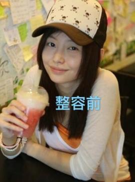 于文文整容前后对比 于文文整容前后对比