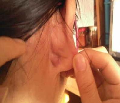 耳朵后面出了个小疙瘩特别疼 耳朵后面出了个小疙瘩特别疼