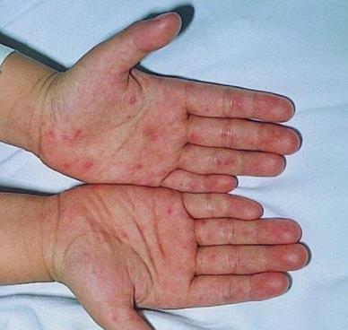 手足口病有哪些症状 手足口病有哪些症状