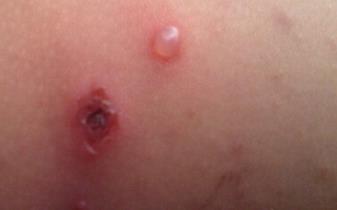 出水痘有什么症状