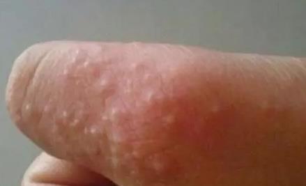 夏天手上会出很多很痒的小水泡 夏天手上会出很多很痒的小水泡