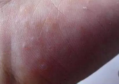 夏天手上会出很多很痒的小水泡 夏天手上会出很多很痒的小水泡