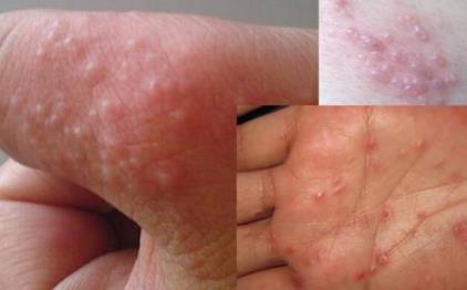 手上出了好多水泡是大病的征兆吗