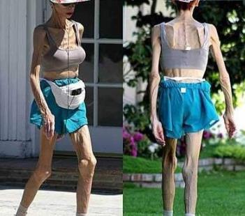 世界上最瘦的人 世界上最瘦的人