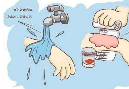 烫伤后伤口处理方法