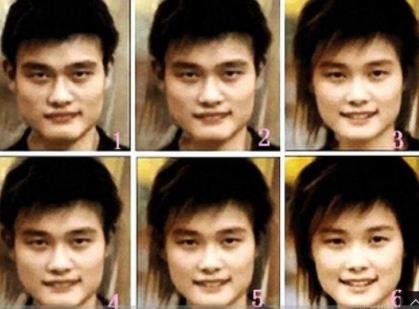 脸盲症是什么：脸盲症有什么症状