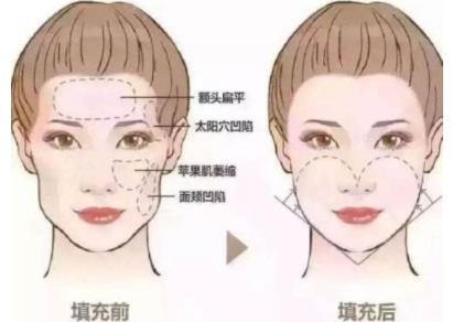 打完玻尿酸注意事项:打完玻尿酸可以睡觉吗 打完玻尿酸注意事项:打完玻尿酸可以睡觉吗