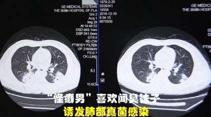 闻臭袜子致肺部感染真的假的：网友纷纷不淡定了