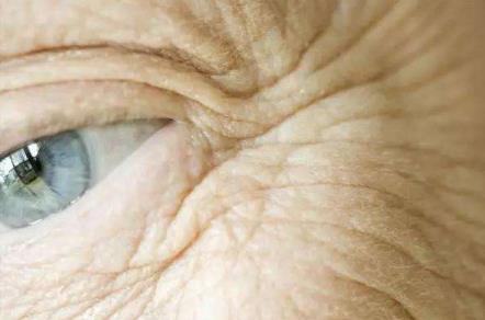 眼部的皱纹怎么去除小窍门，为什么眼部喜欢长皱纹