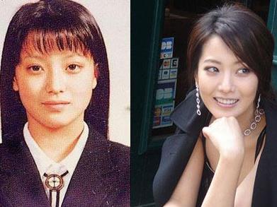 金喜善整容前后对比:后遗症让人害怕