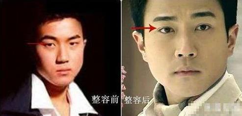刘恺威整容曝光:刘恺威整容前后对比照