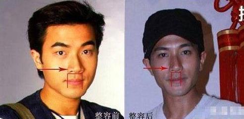 刘恺威整容曝光:刘恺威整容前后对比照