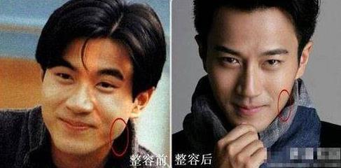 刘恺威整容曝光:刘恺威整容前后对比照