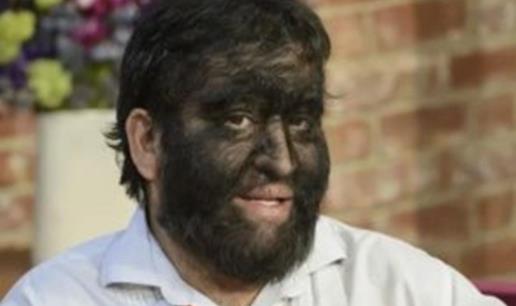 16个孩子变成狼人怎么回事 背后原因曝光让人愤怒