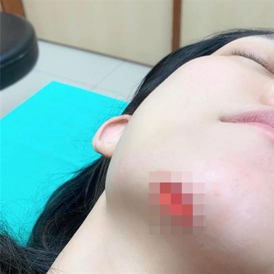 范玮琪下巴缝15针 下巴受伤为什么反遭猜测怀孕 范玮琪下巴缝15针 下巴受伤为什么反遭猜测怀孕