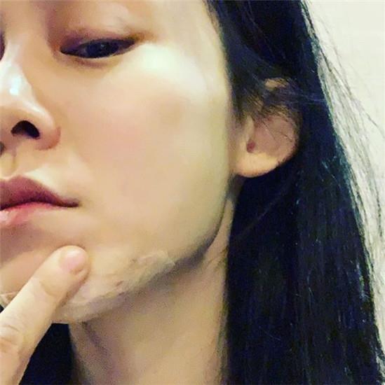 范玮琪下巴缝15针 下巴受伤为什么反遭猜测怀孕 范玮琪下巴缝15针 下巴受伤为什么反遭猜测怀孕