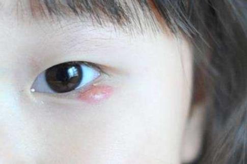 肖战麦粒肿上热搜了 麦粒肿什么症状怎么治疗 肖战麦粒肿上热搜了 麦粒肿什么症状怎么治疗