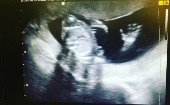 港星杨怡怀孕 晒B超照幸福满满