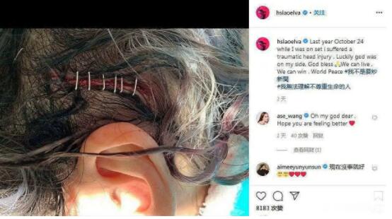 萧亚轩公开意外受伤照片 头部5厘米长的伤口惹人心疼