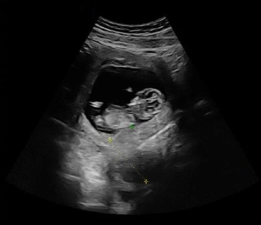 杨祐宁当爸晒宝宝B超照 未婚妻首度公开资料大起底