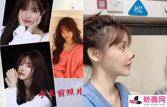 演员高溜整容失败鼻尖坏死是怎么回事 整容前后对比照曝光曾一度轻生