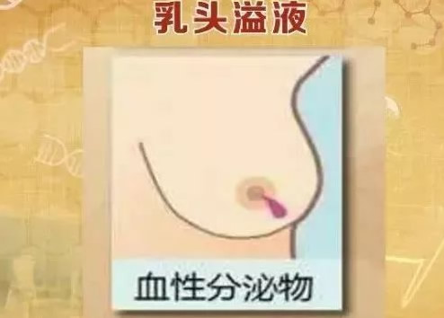 乳腺癌早期症状解读 乳腺癌早期症状解读