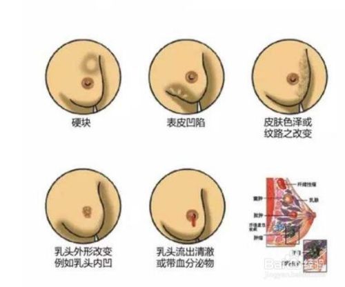 乳腺癌早期症状解读 乳腺癌早期症状解读