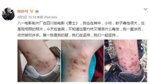 林妙可被毒虫咬伤图片