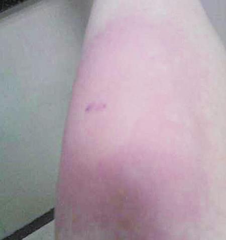 被蜈蚣咬了伤口图片:被蜈蚣咬了怎么办(图) 被蜈蚣咬了伤口图片:被蜈蚣咬了怎么办(图)