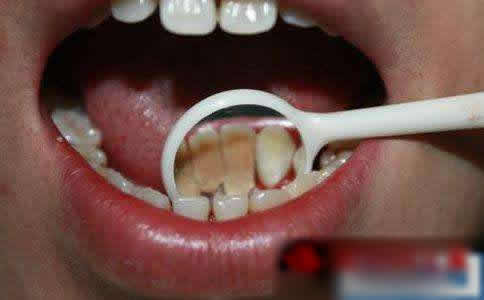 自己动手去除牙石图片:简单易操作的动作 自己动手去除牙石图片:简单易操作的动作