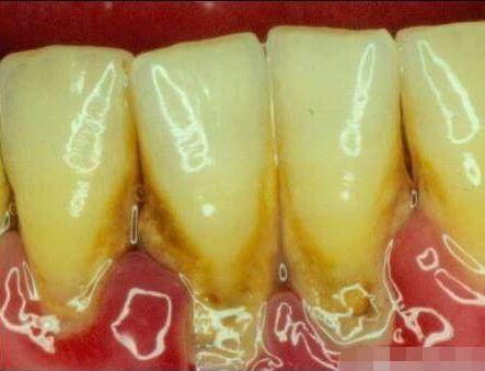 严重的牙石清除小窍门:小小妙招快来学(图) 严重的牙石清除小窍门:小小妙招快来学(图)