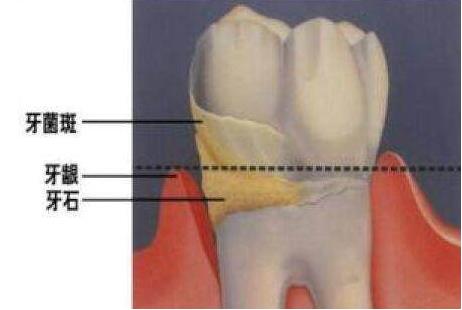 严重的牙石清除小窍门:小小妙招快来学(图) 严重的牙石清除小窍门:小小妙招快来学(图)