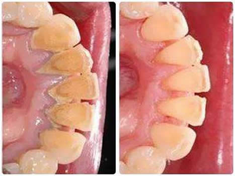 如何去除牙齿结石：3个方法去除牙结石