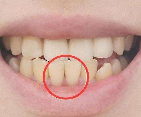 如何去除牙齿结石：3个方法去除牙结石