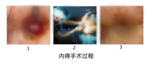 痔疮是长什么样图片:痔疮图片女性,痔疮最佳治疗方法 痔疮是长什么样图片:痔疮图片女性,痔疮最佳治疗方法