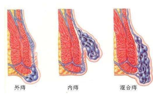 痔疮偏方19个民间方法:民间流传有效简单实用 痔疮偏方19个民间方法:民间流传有效简单实用
