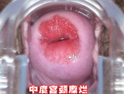 宫颈糜烂是怎么引起的:长期宫颈糜烂会病变吗（图）