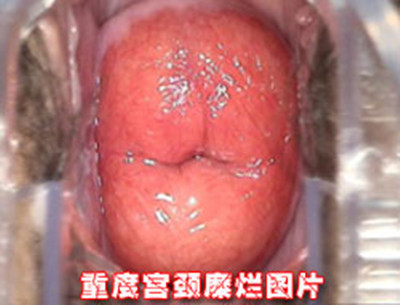 宫颈糜烂是怎么引起的:长期宫颈糜烂会病变吗（图）