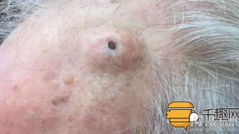 挤出世界上最大的黑头：看医生挤出十年大黑头（图）