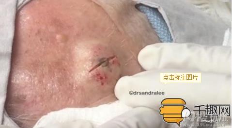挤出世界上最大的黑头：看医生挤出十年大黑头（图）