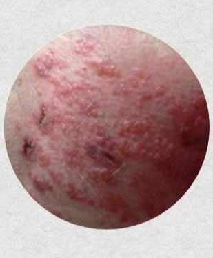 带状疱疹怎么治疗:带状疱疹好痒,带状疱疹会传染吗 带状疱疹怎么治疗:带状疱疹好痒,带状疱疹会传染吗