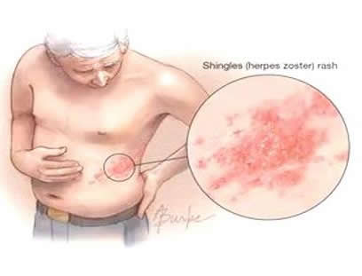 带状疱疹怎么治疗:带状疱疹好痒,带状疱疹会传染吗 带状疱疹怎么治疗:带状疱疹好痒,带状疱疹会传染吗