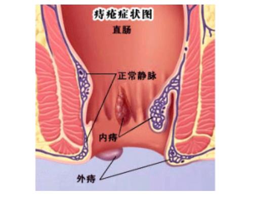 内痔疮和外痔疮区别:看图区分内痔疮和外痔疮 内痔疮和外痔疮区别:看图区分内痔疮和外痔疮