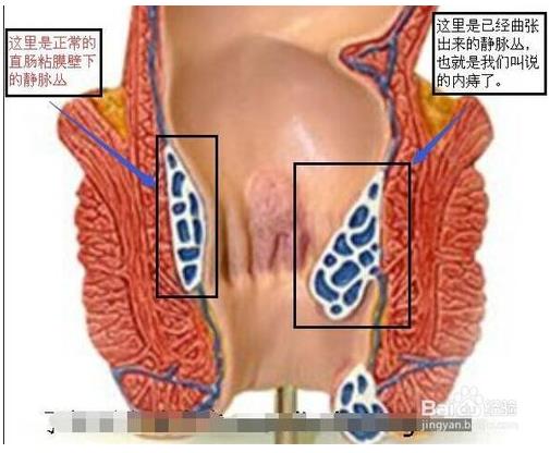 内痔疮和外痔疮区别:看图区分内痔疮和外痔疮 内痔疮和外痔疮区别:看图区分内痔疮和外痔疮