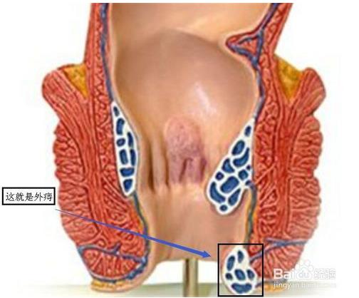 内痔疮和外痔疮区别:看图区分内痔疮和外痔疮 内痔疮和外痔疮区别:看图区分内痔疮和外痔疮