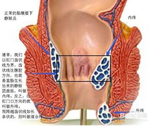 内痔疮和外痔疮区别:看图区分内痔疮和外痔疮 内痔疮和外痔疮区别:看图区分内痔疮和外痔疮
