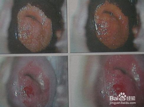 宫颈糜烂什么原因导致的：宫颈糜烂6大原因须知