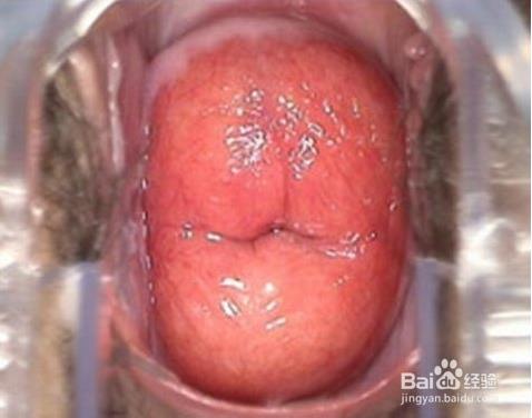 宫颈糜烂什么原因导致的：宫颈糜烂6大原因须知