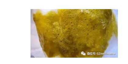 小儿痢疾大便图片：小儿痢疾图片,症状及其危害