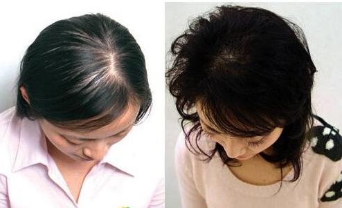 掉头发是什么原因：男女必知掉头发十大原因